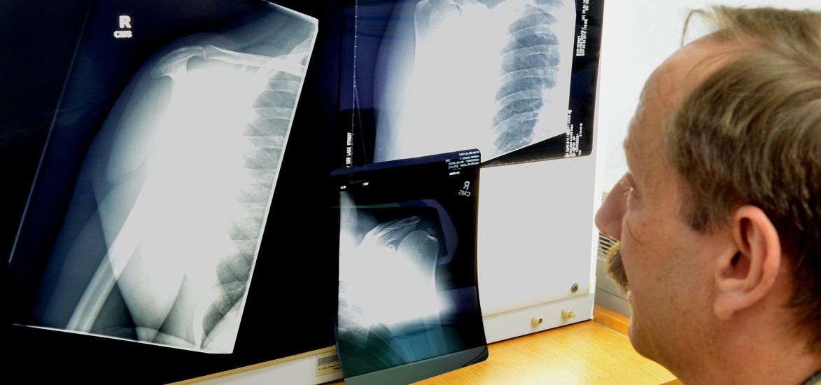 Atherton Hip Transplants